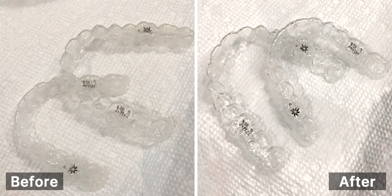 cleaning-retainer-with-ultrasonic-cleaner-before-and-after